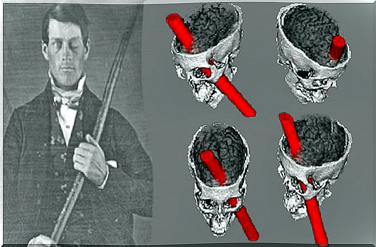 Phineas Gage as an example of clinical cases 